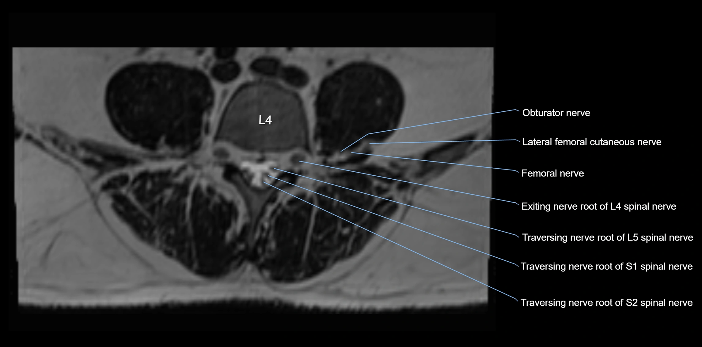 MR lumbosacral plexus axial cross sectional anatomy 3T  radiology  image-img-1008001-00042.webp